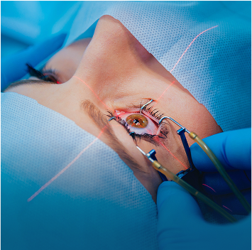 Cirugía de Estrabismo